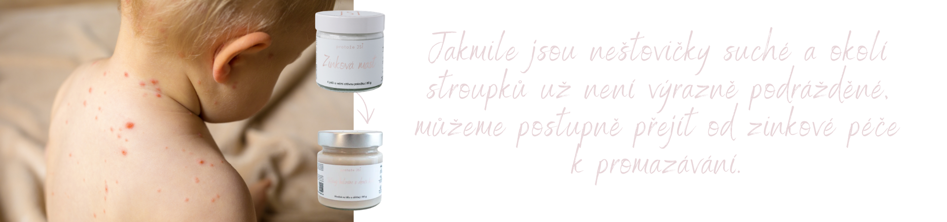neštovice péče zinková mast protože jsi
